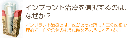 インプラント治療を選択するのは、なぜか？