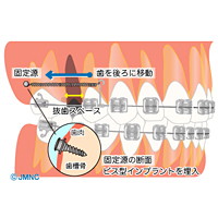 インプラント矯正