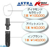 クラウン:インプラントの上の被せ物