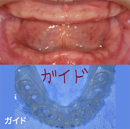 上下総入れ歯の患者の治療例