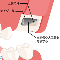 骨再生治療（骨が薄い・足りない方）