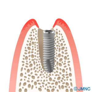 抜歯してすぐにインプラントを埋め込む