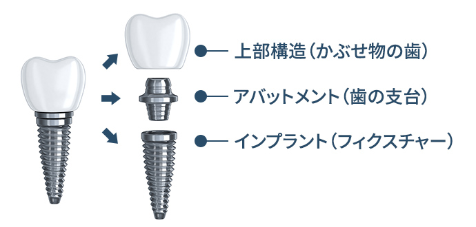 インプラント埋入治療費