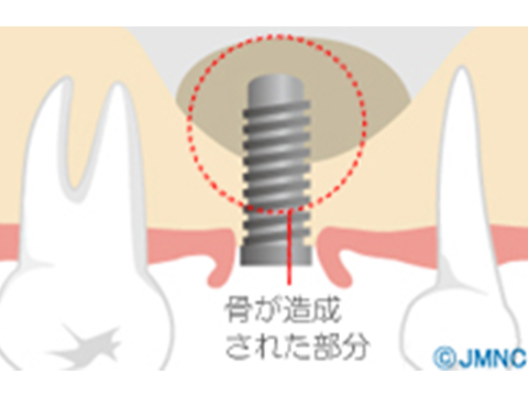 上顎洞底挙上術（ソケットリフト）