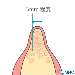 骨量や歯の状態を確認し、手術に必要な骨幅が3ミリ以上あることを確認します。