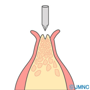 歯肉に麻酔をし、専用の器具を使用して穴をあけます