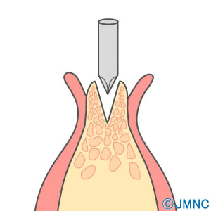 だんだんと骨を広げ、インプラントが十分に入る大きさまで幅を広げていきます。