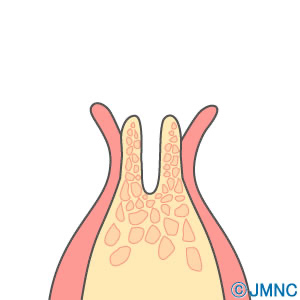 形成した穴にインプラントを埋め込みます。