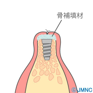 骨とインプラントのすき間を骨補填材で満たして縫合し、骨の再生を待ちます。骨の再生後、二次手術・歯の装着へと進みます。