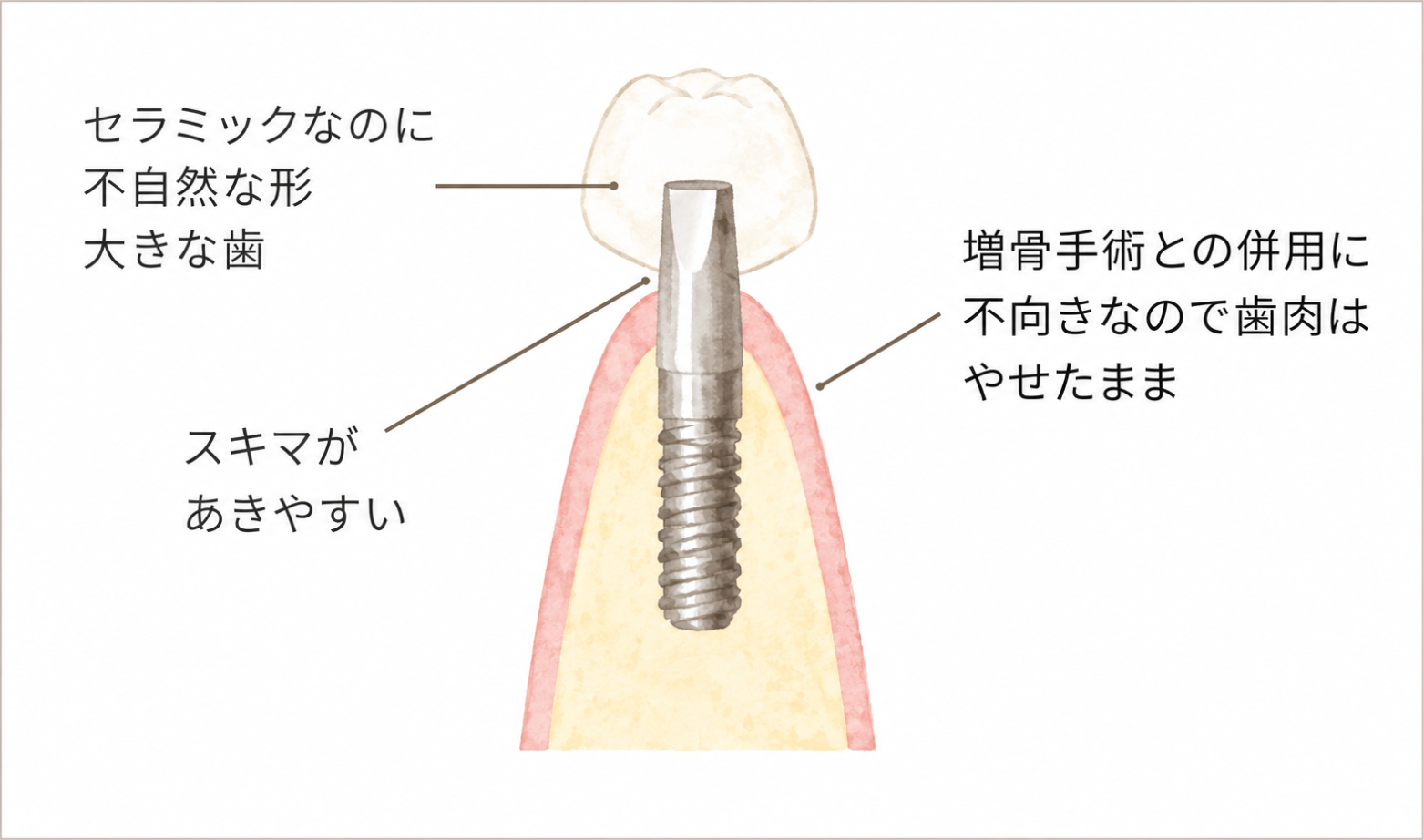 ワンピースインプラントのバランス