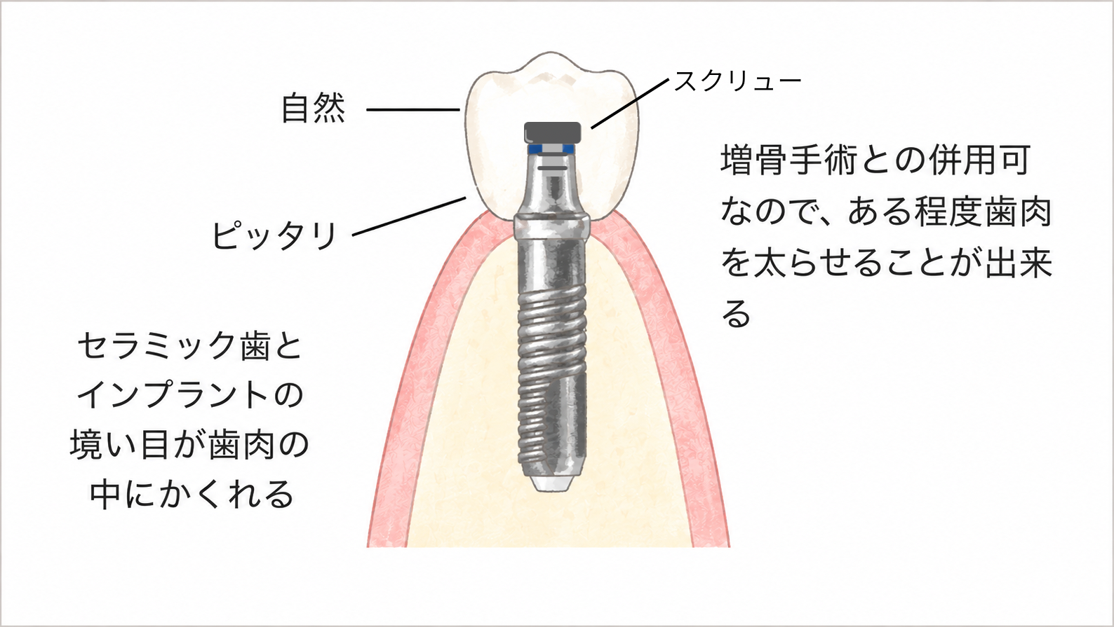 ツーピースインプラントのバランス
